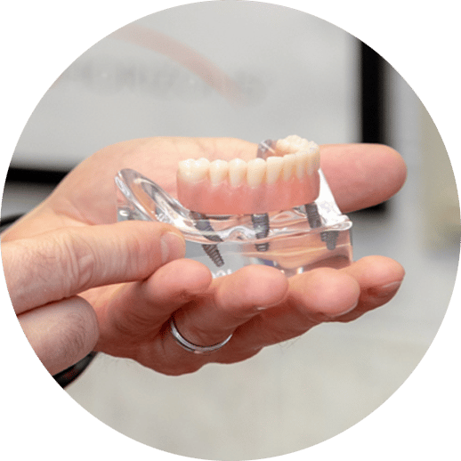 dental implants mode