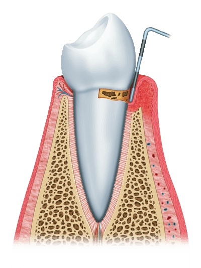 gum disease graphic stage 1