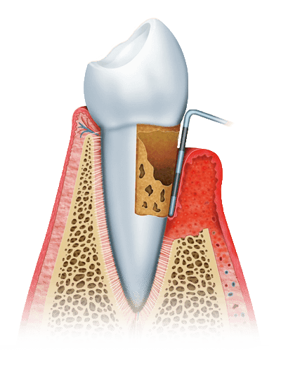 gum disease graphic stage 3