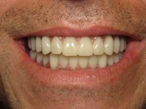 man with perfect teeth after treatment