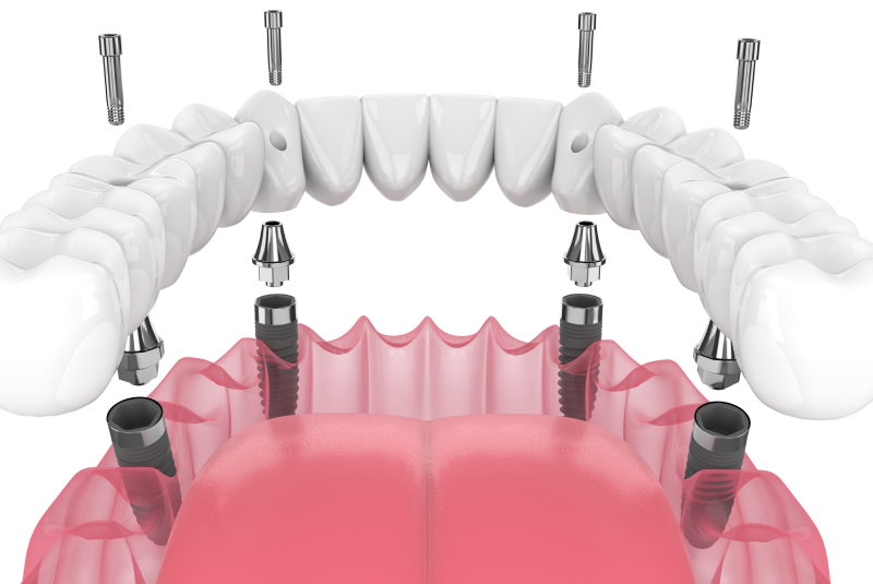 All-on-4 dental implants