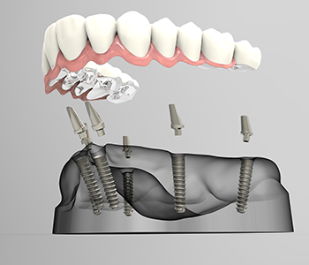 All-on-4 dental implant cost