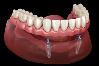process of getting implant supported dentures