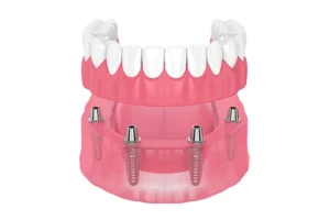 What are implant supported dentures