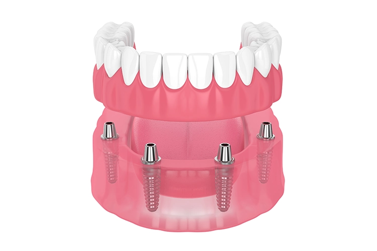 What are implant supported dentures