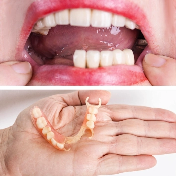 Alternative to dental implants