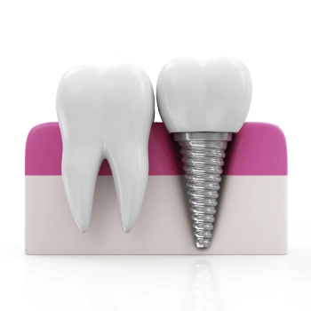 How Long Does It Take To Recover From Dental Implant